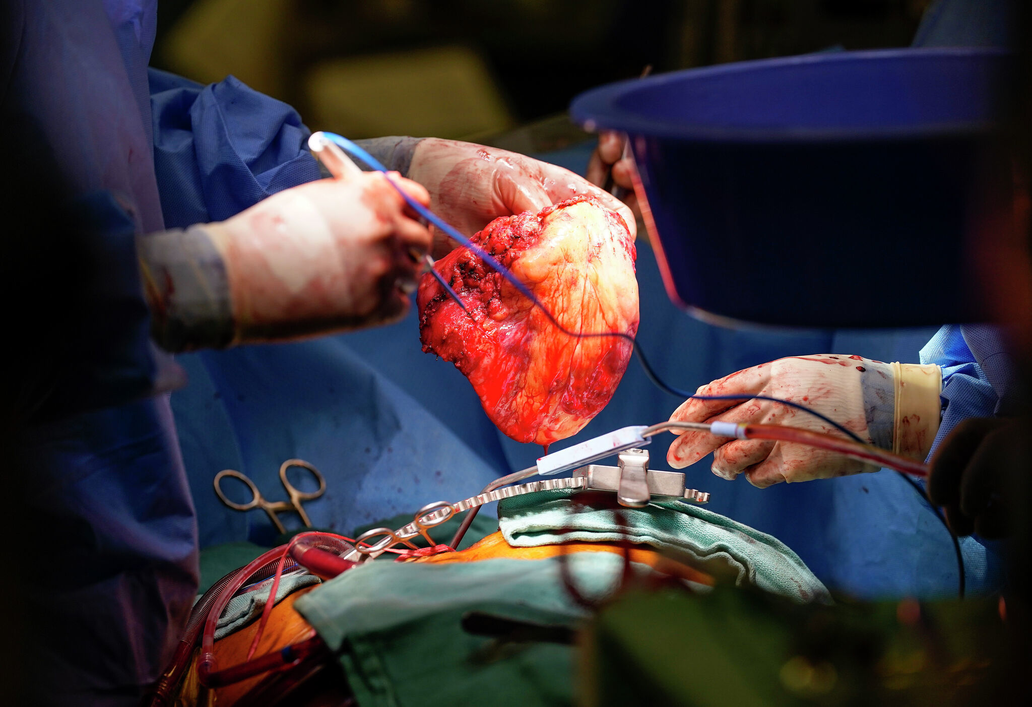 تنها ۲۰ درصد متقاضیان در لیست انتظار، موفق به دریافت قلب پیوندی می شوند