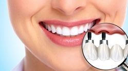 ایمپلنت دندان در بیماران دیابتی: بررسی شرایط، ریسک‌ها و توصیه‌های تخصصی برای موفقیت