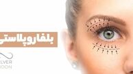 بلفاروپلاستی: راهنمای کامل جراحی پلک برای جوان‌سازی چشم‌ها