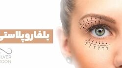 بلفاروپلاستی: راهنمای کامل جراحی پلک برای جوان‌سازی چشم‌ها