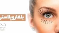 بلفاروپلاستی: راهنمای کامل جراحی پلک برای جوان‌سازی چشم‌ها