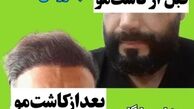توصیه‌های دکتر مقصودلو برای حفظ تراکم مو بعد از کاشت